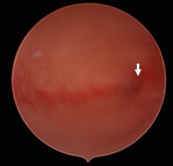 This diagnostic endoscopic image captures the internal view of a uterine cavity during a hysteroscopy. The image demonstrates the characteristic morphology of a unicornuate uterus, a Müllerian duct anomaly. The endometrial lining appears intact with a healthy reddish-pink hue and a smooth surface texture. A white arrow points toward a specific anatomical landmark, identified as the single left tubal ostium, which confirms the absence of a second communicating horn. A horizontal band of hyperemic tissue suggests variations in vascularity across the endometrium. No intracavitary lesions, adhesions, or polyps are visible, indicating a normal environment for future embryo transfer. This visual is typical of an infertility workup evaluating uterine cavity patency and endometrial health in patients with known congenital uterine anomalies.