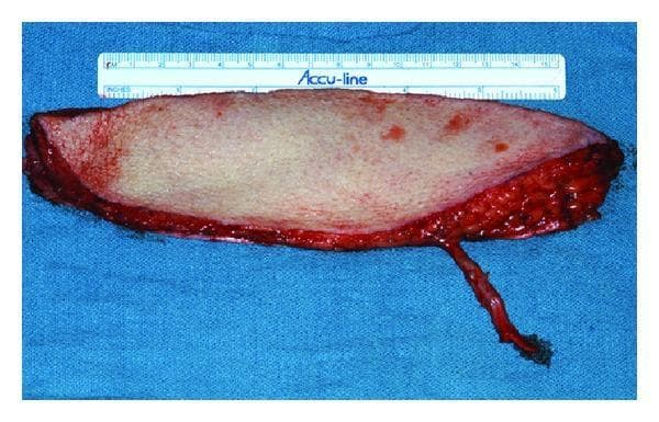 This clinical photograph displays a harvested anterolateral thigh (ALT) free flap, a versatile tool in reconstructive plastic surgery. The flap is shown ex vivo on a sterile blue surgical drape, accompanied by a measurement ruler for scale. The skin paddle is elongated and elliptical, featuring a pale, uniform cutaneous surface. The deep margin reveals harvested subcutaneous adipose tissue and fascia with characteristic reddish, irregular, and raw textures. A prominent feature is the long vascular pedicle, a slender tubular structure extending from the inferior aspect of the flap, which provides the necessary blood supply (artery and venae comitantes) for microsurgical anastomosis at the recipient site. This visual demonstrates the significant tissue volume and generous pedicle length typical of the ALT flap, making it ideal for large soft tissue defects, such as those resulting from head and neck cancer resections. Educational focus is on surgical flap anatomy, vascular pedicle identification, and tissue composition for microsurgical reconstruction.