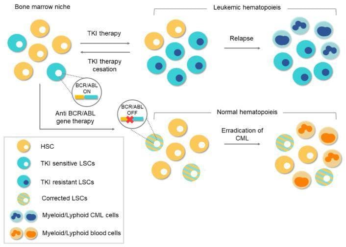 A comparative medical illustration detailing therapeutic pathways for Chronic Myeloid Leukemia (CML) within the bone marrow niche. The diagram contrasts conventional Tyrosine Kinase Inhibitor (TKI) therapy with Anti-BCR/ABL gene therapy. The top pathway illustrates 'Leukemic Hematopoiesis': following TKI therapy, a mixed population of yellow Hematopoietic Stem Cells (HSCs), light blue TKI-sensitive Leukemic Stem Cells (LSCs), and dark blue TKI-resistant LSCs is shown. Treatment cessation or resistance leads to relapse, characterized by the proliferation of myeloid/lymphoid CML cells. The lower pathway depicts the potential of gene therapy: 'Anti-BCR/ABL gene therapy' targets LSCs to silence the oncogene (BCR/ABL OFF). This results in 'Corrected LSCs' (depicted with yellow and blue stripes), which repopulate the niche alongside normal HSCs. The final outcome is 'Normal Hematopoiesis' and the eradication of CML, visualised by the presence of mature myeloid/lymphoid blood cells (orange). The diagram serves as an educational tool for hematology and oncology, emphasizing the limitations of protein-level inhibition versus genome-level editing in stem cell niches.
