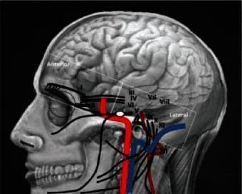 This medical illustration presents a lateral projection of the human cranial region, serving as an anatomical diagram of the skull base, brain, and neurovascular structures. The image overlays a detailed skull rendering with the cerebral hemispheres, emphasizing cortical gyri and sulci. A key feature is the schematic mapping of the twelve cranial nerves (labeled I–XII in Roman numerals), showing their approximate pathways as they exit the brainstem and navigate through skull base foramina. Major vascular structures are highlighted in red (arterial, including the internal carotid artery) and blue (venous), demonstrating their close spatial proximity to the cranial nerves near the zygomatic arch and mandible. The diagram includes orientation labels for 'Anterior' and 'Lateral' perspectives. It is designed for clinical education in neuroanatomy and skull base surgery, illustrating the complex topographic relationships essential for diagnostic imaging and surgical planning in procedures such as microvascular decompression or tumor resection.