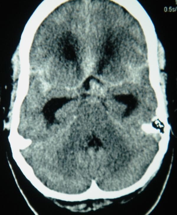 This unenhanced axial computed tomography (CT) scan of the brain demonstrates a diffuse subarachnoid hemorrhage (SAH). High-attenuation (hyperdense) signals indicative of acute blood are prominently visible within the subarachnoid spaces, particularly filling the basal cisterns and extending into the Sylvian fissures. A focal area of increased density is notably localized in the prepontine cistern, suggesting a potential site of vascular rupture, such as a basilar artery or posterior communicating artery aneurysm. The ventricular system appears mildly enlarged, and the surrounding brain parenchyma shows typical differentiation, though the diffuse hyperdensity in the cisterns obscures normal cerebrospinal fluid (CSF) spaces. This diagnostic image is a classic representation of acute intracranial hemorrhage and is highly relevant for neurology and neurosurgery education regarding the CT appearance of aneurysmal SAH.