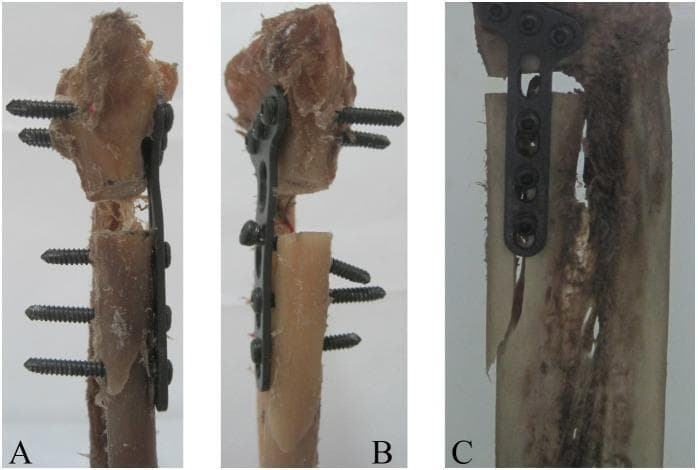 Clinical photograph of three anatomical bone specimens (A, B, and C) demonstrating catastrophic failure modes of distal radius volar plate fixation following biomechanical testing. The specimens show different internal fixation constructs using anatomical locking plates and screws for distal radius fractures. Image A illustrates a failure characterized by the collapse of the distal radius diaphysis at the osteotomy site and slight bending/deformation of the mid-plate. Image B shows failure through diaphyseal collapse accompanied by the uncoupling of a proximal locking screw from the plate hole, representing a mechanical breakdown of the screw-plate interface. Image C displays extensive comminution and splintering of the bone with failure occurring through secondary fractures near the implant site. These images serve as educational material for orthopedic surgery, specifically focusing on traumatology, fracture fixation stability, and the mechanical limits of volar locking distal radius plates in cadaveric models.