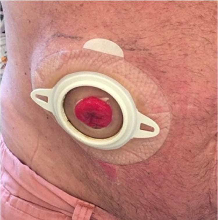 This clinical photograph shows a close-up view of a post-operative abdominal stoma, specifically a colostomy or ileostomy, 28 days following a surgical procedure for stoma prolapse correction. The stoma itself is a healthy, reddish-pink, moist, and rounded protrusion of intestinal mucosa located in the center of the appliance. It is positioned within a white, circular plastic flange of a two-piece ostomy system. The flange is mounted on a beige, textured, skin-protective adhesive wafer (barrier) that adheres to the patient's abdominal skin. The surrounding skin appears mostly intact, with subtle erythema visible near the lower edge of the adhesive patch, possibly indicating minor peristomal skin irritation or post-surgical changes. The image serves as a clinical example of successful stoma management and appliance fitting following the surgical repair of a prolapse using a polypropylene mesh technique.