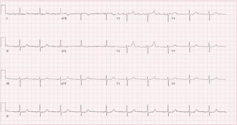 A 12-lead electrocardiogram (ECG) printed on standard grid paper, featuring leads I, II, III, aVR, aVL, aVF, and V1 through V6, with a long rhythm strip of lead II at the bottom. The tracing demonstrates classic features of atrial fibrillation, characterized by an 'irregularly irregular' ventricular rhythm evidenced by varying R-R intervals. There is a notable absence of distinct, organized P waves; instead, the baseline shows low-amplitude fibrillatory waves, particularly visible in the inferior leads (II, III, aVF) and V1. The QRS complexes are narrow (duration <120 ms), indicating normal ventricular conduction. The ventricular rate is relatively controlled, appearing within or near normal limits rather than rapid. ST segments are generally isoelectric, and T-wave morphology appears largely unremarkable across most leads, with no obvious acute ST-segment elevation or depression. This diagnostic image serves as a clinical example of rate-controlled atrial fibrillation for cardiovascular education.