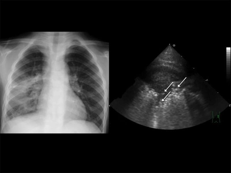 A multi-modal diagnostic image panel for pediatric pneumonia. (Left) An anteroposterior chest radiograph demonstrates a significant area of opacity in the right lower lobe, consistent with lung consolidation. The left lung remains relatively clear and air-filled. (Right) A corresponding transthoracic ultrasonography (TUS) of the right anterior lower lung showing a hepatized lung appearance (consolidation). The ultrasound features multiple punctate, hyperechoic (bright) spots indicated by white arrows, which represent static or dynamic air bronchograms—bubbles of air trapped within the consolidated, fluid-filled lung tissue. The clinical significance of this combination is to demonstrate the correlation between traditional radiography and point-of-care ultrasound in diagnosing community-acquired pneumonia (CAP) in children. Target educational concepts include identifying consolidation on X-ray and recognizing sonographic air bronchograms as a hallmark of pneumonia.