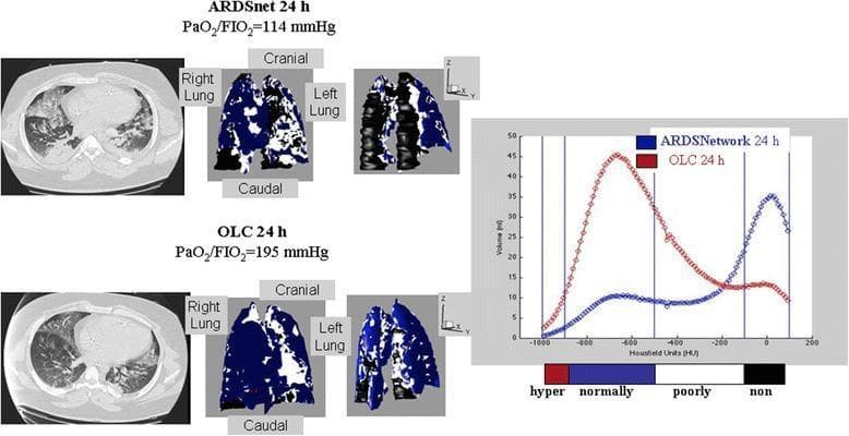 This medical comparison chart displays axial CT scans, 3D lung reconstructions, and voxel distribution histograms comparing two mechanical ventilation strategies in Acute Respiratory Distress Syndrome (ARDS): ARDSnet-24h and Open Lung Concept (OLC)-24h. The top panel (ARDSnet) shows significant bilateral dorsal atelectasis, represented in the 3D model by large black regions (non-aerated tissue) and poorly aerated white areas. Its corresponding histogram shows a bimodal distribution with a prominent peak in the non-aerated range (> -100 Hounsfield Units). The bottom panel (OLC) demonstrates improved alveolar recruitment, evidenced by a shift in the 3D model to predominantly blue (normally aerated) tissue and a reduction in black dorsal collapse. The OLC histogram shows a unimodal distribution with a primary peak in the normally-aerated range (-900 to -500 HU) and a higher PaO2/FiO2 ratio (195 vs 114 mmHg). This clinical imaging study illustrates the efficacy of recruitment maneuvers and PEEP titration in achieving more homogeneous lung aeration and reducing intrapulmonary shunt in critically ill patients.