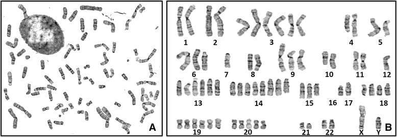 This diagnostic image displays a G-banded karyotype analysis of the SHG139 human glioma cell line, presented in two panels. Panel A shows a metaphase spread with chromosomes dispersed randomly across the field, alongside a speckled interphase nucleus. The chromosomes exhibit characteristic dark and light banding patterns used for identification. Panel B presents the organized karyotype, with chromosomes arranged and numbered from 1 to 22, plus sex chromosomes (X, Y). The karyotype demonstrates significant numerical abnormalities (aneuploidy) and structural variations typical of malignant glioma cells. Notable findings include a complex polyploid state with varying copy numbers: monosomy of chromosomes 7, 12, X, and Y; disomy of 1, 2, 4, 5, 8, 10, 11, 17, 21, and 22; and high-level gains (polysomy) of others, specifically six copies of 3, 13, and 19, and eight copies of chromosome 14. A complete deletion of chromosome 16 is also evident. This visual serves as an educational example of genomic instability and complex chromosomal rearrangements in primary CNS tumors.