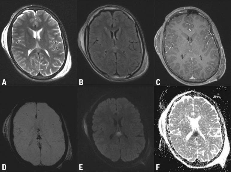 Six axial brain MRI sequences (A-F) demonstrate diagnostic features of Diffuse Axonal Injury (DAI) following Traumatic Brain Injury (TBI). The primary intra-axial lesion is located in the splenium of the corpus callosum. In T2-weighted (A) and FLAIR (B) images, the lesion appears hyperintense. It shows no enhancement on post-contrast T1-weighted imaging (C), suggesting an intact blood-brain barrier. Susceptibility Weighted Imaging (SWI, D) reveals a low signal intensity indicative of microhemorrhages. Diffusion-weighted imaging (DWI, E) shows a high signal, while the corresponding ADC map (F) shows low signal, confirming restricted diffusion characteristic of cytotoxic edema in acute axonal injury. Additionally, prominent extra-axial bilateral subgaleal hematomas are visible, appearing as fluid collections between the calvarium and scalp with variable signal across sequences. The image set illustrates the superiority of multi-parametric MRI over CT for identifying non-hemorrhagic and microscopic shear injuries in the white matter pathways.