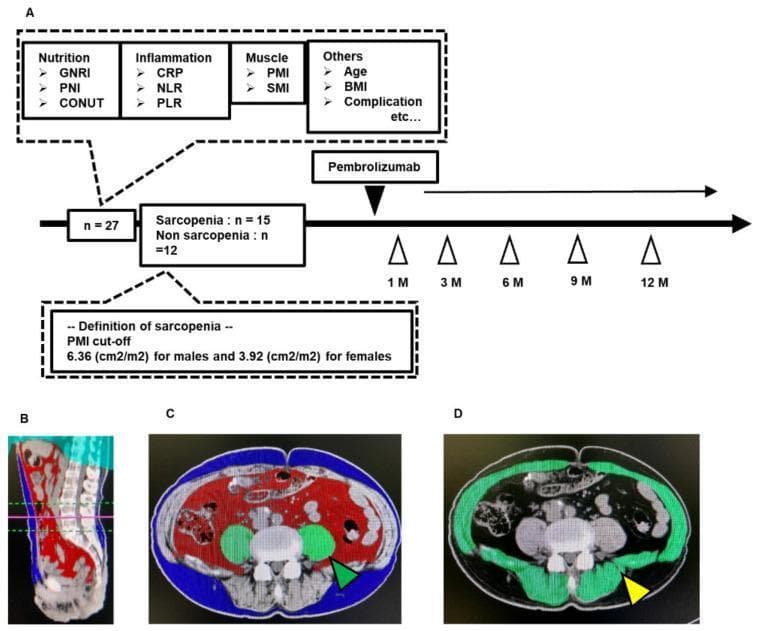 Educational figure illustrating a clinical study workflow and diagnostic imaging for body composition analysis in patients with urothelial carcinoma. Section A presents a flowchart detailing the assessment of 27 patients before and during Pembrolizumab treatment, highlighting biomarkers for nutrition (GNRI, PNI, CONUT), inflammation (CRP, NLR, PLR), and muscle mass (PMI, SMI). It defines sarcopenia based on sex-specific psoas muscle index (PMI) cut-offs. Sections B, C, and D showcase abdominal computed tomography (CT) images processed with the SYNAPSE VINCENT analysis system. Figure B provides a 3D sagittal reconstruction at the L3 level. Figure C is a color-coded axial/coronal slice differentiating abdominal subcutaneous adipose tissue (blue), visceral adipose tissue (red), and the psoas muscle (green, green arrow). Figure D identifies the total skeletal muscle area at the L3 level in green (yellow arrow). The visual demonstrates the quantitative radiological assessment of sarcopenia and body composition as prognostic factors in oncological management.