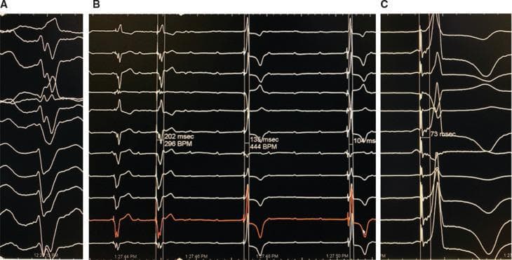 This diagnostic image consists of three panels (A, B, and C) showing multi-lead electrocardiogram (ECG) tracings recorded during a His bundle pacing (HBP) procedure in a patient with iatrogenic complete heart block. Panel A displays a Left Bundle Branch Block (LBBB) morphology with wide QRS complexes and left axis deviation. Panel B compares right ventricular (RV) pacing with non-selective His bundle pacing (NS-HBP). The first two beats show wide QRS complexes (202 msec) characteristic of RV pacing, while the subsequent beats demonstrate the transition to NS-HBP with a significantly narrower QRS duration (135 msec) and altered repolarization. Panel C illustrates a narrow QRS complex (73 msec) achieved via NS-HBP, characterized by increased voltage in lead I, normalization of the frontal QRS axis, and improved R-wave progression in the precordial leads. These findings highlight the educational concept of physiological pacing as an alternative to conventional ventricular pacing for correcting bundle branch blocks and maintaining electrical synchrony.