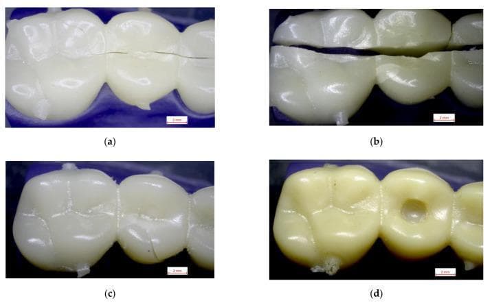 A comparison of fracture mechanics in dental restorative materials, presented through four intraoral-style photographs of prosthetic dental bridges (occlusal view). The images illustrate different material failure patterns under mechanical stress: (a) PMMA shows a longitudinal linear crack across the occlusal surfaces, characteristic of brittle failure. (b) Graphene-reinforced polymer (GRA) demonstrates a catastrophic failure, with a complete, sharp-edged fracture separating the prosthesis into two distinct segments. (c) Reinforced acrylic (RA) shows localized, non-linear micro-cracks on the occlusal table. (d) Polystyrene (PS) exhibits ductile behavior; instead of fracturing, the material shows significant plastic deformation and a central circular perforation from crushing force. The collection serves as an educational tool for dental biomaterials science, highlighting the clinical significance of fracture toughness and material deformation (brittle vs. ductile) in fixed prosthodontics.