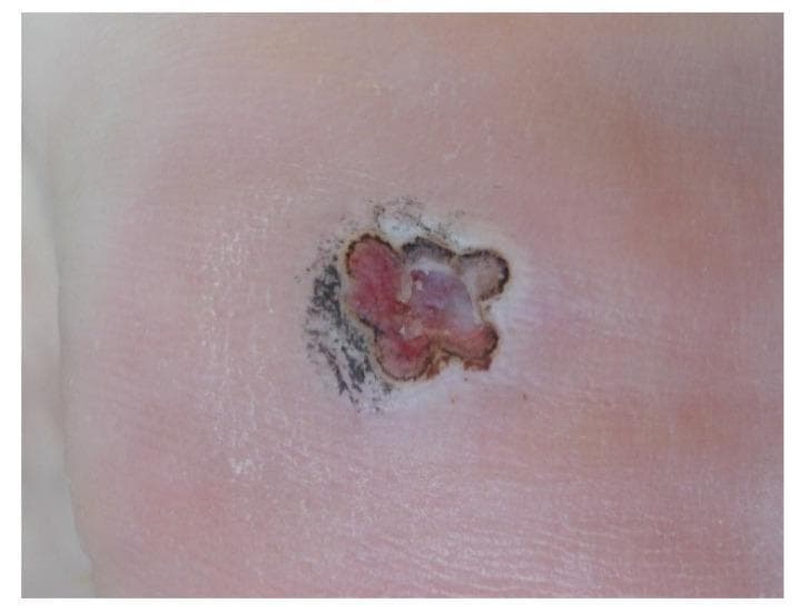 This clinical photograph displays a follow-up view of a plantar wart (Verruca plantaris) on the foot, one week post-laser treatment using an India ink chromophore. The lesion, which is greater than 4 mm in diameter, shows a central zone of reddish-purple and pinkish granulation tissue or inflammation. This central area is bordered by a thin, dark, almost black ring, likely representing remnants of the India ink or charred tissue from the laser irradiation. The overall morphology is roughly circular with irregular, non-uniform borders. The immediate periphery of the lesion exhibits a lighter, whitish-pink hue indicative of localized inflammation or re-epithelialization, transitioning into the normal surrounding skin tone. The skin texture at the site appears slightly raised and uneven, typical of a healing wound after the removal of hyperkeratotic tissue. This image illustrates the clinical progression and tissue reaction during the healing phase of laser-treated recalcitrant plantar warts.