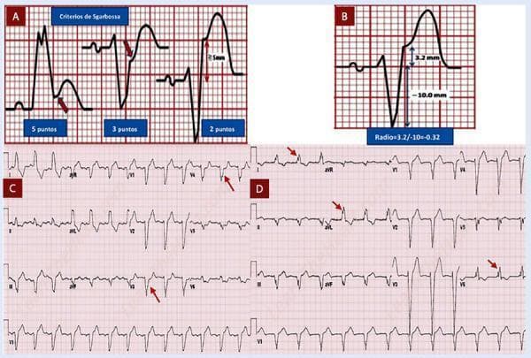 Educational infographic and diagnostic ECG traces detailing electrocardiographic criteria for myocardial infarction in the presence of Left Bundle Branch Block (LBBB). Panel A illustrates the Sgarbossa criteria: concordant ST-elevation ≥ 1mm (5 points), concordant ST-depression ≥ 1mm in leads V1-V3 (3 points), and discordant ST-elevation ≥ 5mm (2 points). Panel B displays the Modified Sgarbossa (Smith) criterion, focusing on the ST/S ratio (ST-elevation amplitude relative to S-wave depth). Panel C presents the Cabrera-Friedland criterion on a 12-lead ECG, marked by red arrows indicating a notch ≥ 50ms in the ascending limb of the S-wave in precordial leads V3-V4. Panel D highlights the Chapman-Pearce criterion, with red arrows identifying a notch in the ascending limb of the R-wave in leads I, aVL, and V6. These visual aids serve as diagnostic tools for identifying ST-segment elevation myocardial infarction (STEMI) when traditional ECG interpretation is confounded by baseline conduction abnormalities like LBBB.