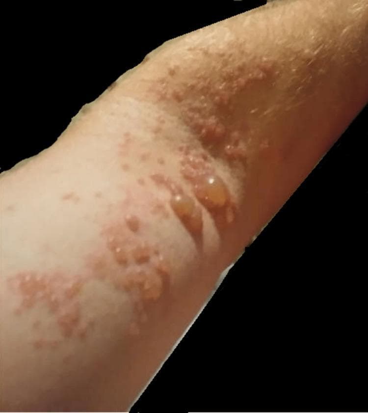 A clinical photograph of the left upper extremity demonstrating a vesicular and bullous eruption characteristic of Herpes Zoster (shingles). The rash exhibits a dermatomal distribution, featuring clusters of lesions on an erythematous base. Morphologically, the lesions range from small, grouped vesicles filled with clear fluid to larger, tense, dome-shaped bullae measuring over one centimeter. Several lesions appear ruptured or umbilicated, resulting in shallow erosions and crusting. The surrounding skin shows signs of inflammation and localized hyperemia. This visual presentation is indicative of Varicella-Zoster Virus (VZV) reactivation, illustrating the classic presentation of painful cutaneous lesions confined to a specific nerve root territory (C5-C6), often associated with neuropathic pain and potential motor weakness in the affected limb.