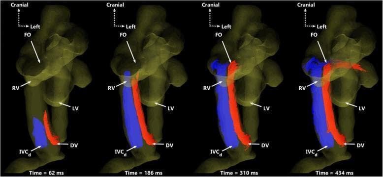 This diagnostic image series utilizes 4D flow MRI-derived particle tracing to illustrate fetal circulatory dynamics in a ventral view. The visualization demonstrates the preferential streaming of blood from two distinct venous sources over one cardiac cycle (62 ms, 186 ms, 310 ms, and 434 ms). Red particles represent blood from the ductus venosus (DV), while blue particles represent blood from the distal inferior vena cava (IVCd). The series highlights the maintenance of separate flow streams within the proximal inferior vena cava. The red DV stream is directed preferentially through the foramen ovale (FO) toward the left ventricle (LV) to supply oxygenated blood to the systemic circulation. Concurrently, the blue IVCd stream is routed primarily toward the right ventricle (RV) for delivery to the main pulmonary artery. Anatomical landmarks labeled include the ductus venosus (DV), distal inferior vena cava (IVCd), foramen ovale (FO), right ventricle (RV), and left ventricle (LV). This pedagogical tool illustrates the physiological shunting essential for fetal development and the minimal mixing of nutrient-rich and nutrient-poor blood streams.