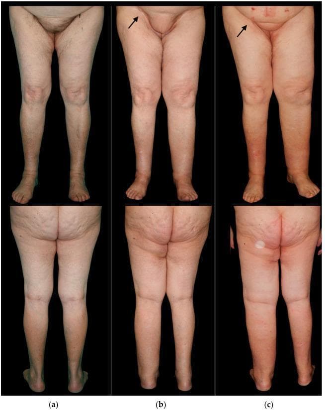 Clinical photographs in frontal and posterior views documenting the long-term progression of lower limb lymphedema in a patient following bilateral groin dissection for vulvar cancer. Panel (a) shows the preoperative baseline with symmetrical limb contours. Panel (b) illustrates the status one year post-surgery, featuring a superficial circumflex iliac artery perforator (SCIP) flap skin island in the right groin (marked with an arrow); the right (treated) leg shows mild swelling, while the left (untreated) leg exhibits moderate lymphedema. Panel (c) shows the 5-year follow-up, demonstrating progressive, severe lymphedema of the left lower limb characterized by significant volumetric increase, loss of anatomical definition at the ankle and knee, and a reddish skin hue indicative of chronic stasis. The right limb remains stable with mild swelling. This timeline demonstrates the efficacy of lymphatic reconstruction (SCIP flap) in mitigating secondary lymphedema compared to the contralateral untreated side. Target educational concepts include postoperative complications of lymphadenectomy, lymphatic flap reconstruction, and clinical staging of chronic lymphedema.