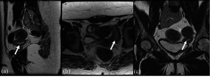 This diagnostic imaging set consists of three T2-weighted magnetic resonance imaging (MRI) views of the female pelvis, illustrating the anatomy of the uterus (indicated by white arrows) following hormonal management. Panel (a) presents a sagittal view, demonstrating the uterus in a pear-shaped longitudinal orientation, positioned posterior to the urinary bladder and anterior to the rectum. Panel (b) provides an axial cross-section, showing the transverse width of the uterine body and its relationship to the lateral pelvic walls and musculature. Panel (c) displays a coronal view, highlighting the frontal plane of the uterus and its relative position within the pelvic cavity. The images show a uterus with intermediate signal intensity and relatively small dimensions (approximately 4.9 x 1.7 x 3.1 cm), which is a significant finding in the context of long-term estrogen replacement therapy. These views collectively provide a comprehensive assessment of uterine morphology, signal characteristics, and spatial orientation (anteversion/retroversion) relative to adjacent pelvic viscera.