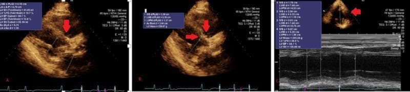 This diagnostic image set consists of three transthoracic echocardiogram panels (A, B, and C) evaluating severe aortic stenosis in a 79-year-old male. Panels A and B demonstrate the parasternal long-axis (PLAX) view, with red arrows highlighting thickened, calcified aortic valve leaflets. These leaflets exhibit significantly reduced mobility and minimal systolic excursion, characteristic of valvular stenosis. Overlaid measurement boxes provide quantitative data, including left ventricular internal diameter in diastole (LVIDd) of approximately 5.4 cm and a preserved ejection fraction (EF) around 54-60%. Panel C presents an M-mode echocardiogram across the left ventricle, illustrating wall thickness and chamber dimensions, with a calculated LV mass of 295.54 g suggesting compensatory hypertrophy. The M-mode also captures the narrow aortic valve orifice. Key anatomical structures visible include the left atrium, left ventricle, and aortic root. This visual content is essential for understanding the diagnostic criteria for severe aortic stenosis, emphasizing both structural leaflet morphology and hemodynamic impact on ventricular function.