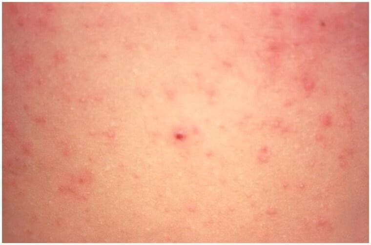 This clinical photograph displays a close-up view of a cutaneous eruption on the human abdomen, characteristic of a scabies infestation (Sarcoptes scabiei). The image demonstrates numerous small, erythematous papules (red, raised bumps) scattered across a light-toned skin background. The lesions exhibit a polymorphic distribution with varying density, accompanied by a diffuse, mild background erythema suggesting a generalized hypersensitivity reaction to the scabies mites, eggs, or scybala (feces). Some papules appear slightly excoriated, which is a common secondary finding due to intense pruritus. The absence of clearly visible linear burrows in this specific frame is typical, as they are often obscured by secondary inflammatory changes or scratching. This image serves as an educational tool for identifying the primary morphology of inflammatory scabietic lesions in common predilection sites like the trunk.