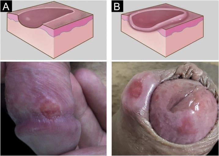 This medical visual contains a comparison of primary syphilis lesions (hard chancres) through graphic illustrations and clinical photographs. Panel A illustrates an early eroded hard chancre, characterized by a rounded shape with a smooth, sloping edge and a shallow, clean base. Below the illustration, a clinical photograph shows a corresponding single, well-defined erythematous ulcer on the shaft of a penis. Panel B illustrates a hard chancre with significant infiltration, depicted with an elevated, thickened, and indurated border that rises above the surrounding skin level. The corresponding clinical photograph shows a larger, raised, and firm-appearing lesion on the inner leaflet of the prepuce or coronal sulcus. These visuals are used to teach the morphological progression of Treponema pallidum infection, specifically the classical appearance of a painless, indurated genital ulcer. The educational focus is on the diagnostic distinction between simple erosion and infiltrated borders in syphilis presentations.