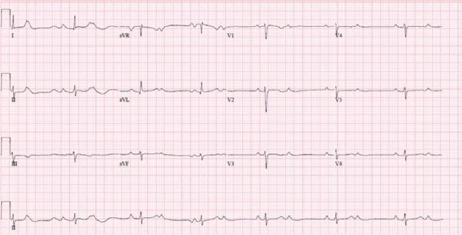 A 12-lead electrocardiogram (ECG) demonstrating Complete Heart Block (CHB) with significant electrophysiological findings. The tracing reveals a classic atrioventricular (AV) dissociation where P waves and QRS complexes occur independently of each other. The atrial rate is approximately 80-90 beats per minute, while the ventricular rate is slower at approximately 40-45 beats per minute. The escape rhythm is characterized by narrow QRS complexes, suggesting a junctional or intra-Hisian level of block. Notably, the tracing exhibits isorhythmic AV dissociation, where the atrial and ventricular rates exist in a near 2:1 ratio, superficially mimicking a second-degree AV block. Additionally, ventriculophasic sinus arrhythmia is present, evidenced by shorter P-P intervals when a QRS complex is interspersed between them compared to P-P intervals without an intervening QRS. The ST segments and T waves are otherwise unremarkable across the precordial and limb leads.