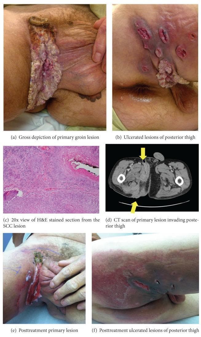 This composite educational graphic illustrates the clinical presentation, histopathology, and imaging of Squamous Cell Carcinoma (SCC) with verrucous features in the groin and thigh. Clinical photographs (a, b) show a large, fungating, exophytic growth in the right inguinal region extending to the posterior thigh, characterized by irregular borders, verrucous texture, and multiple satellite ulcerated lesions. A 20x magnification H&E stained photomicrograph (c) demonstrates superficially invasive malignant keratinocytes consistent with SCC. An axial CT scan of the pelvis (d) highlights an enhancing soft tissue density (arrows) invading the right quadriceps muscle and gluteal folds. Post-treatment photographs (e, f) document the disease progression following chemoradiotherapy, showing a reduction in the primary tumor mass, residual ulceration, and dark necrotic changes at the edges of the posterior thigh lesions. This comparison serves as a clinical timeline for monitoring therapeutic response in advanced cutaneous malignancy.