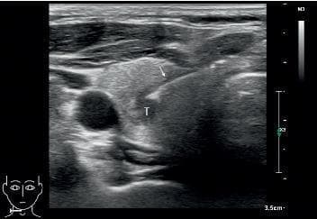 This diagnostic ultrasound image in the transverse plane demonstrates a Fine Needle Aspiration Biopsy (FNAB) of a thyroid nodule. The nodule, labeled 'T', presents as a well-defined structure with heterogeneous echogenicity, appearing predominantly hypoechoic compared to the surrounding isoechoic thyroid parenchyma. A biopsy needle, indicated by a white arrow, is visualized as a highly echogenic (bright) linear structure. The needle is shown using an in-plane approach, where it is positioned parallel to the long axis of the ultrasound probe, allowing for continuous visualization of the needle shaft and tip as it enters the nodule. In the lateral aspect of the thyroid lobe, a prominent anechoic (black) circular structure represents a major neck vessel, likely the carotid artery or internal jugular vein. Superficial to the thyroid, the strap muscles are visible as stratified, hypoechoic bands. This image serves as a clinical example of real-time ultrasound guidance to ensure precise needle placement and adequate tissue sampling in the evaluation of thyroid pathology.