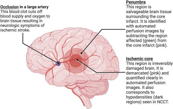 This medical illustration depicts the pathophysiology of an acute ischemic stroke resulting from a large vessel occlusion (LVO). The central anatomical structure is a lateral view of the human brain with its arterial network. A dark blue thrombus is shown occluding a major cerebral artery, leading to downstream tissue ischemia. The diagram categorizes the affected neural tissue into two primary zones: the 'Ischemic Core' and the 'Penumbra'. The Ischemic Core, highlighted in a darker pink/red circular region, represents irreversibly damaged (infarcted) brain tissue, which correlates with hypodensities on non-contrast CT (NCCT). Surrounding this is the Penumbra, shown in a lighter red shade, which represents salvageable brain tissue at risk. The educational focus is on the rationale for endovascular thrombectomy (EVT), where automated perfusion imaging identifies the 'mismatch' between the core and the total affected area (green region in perfusion scans) to select patients for intervention. This diagram serves as a clinical teaching tool for understanding stroke neuroimaging and the selection criteria for reperfusion therapies.