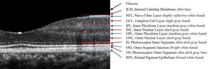 This diagnostic image is a cross-sectional optical coherence tomography (OCT) scan of a healthy human retina centered at the macula. The image provides a high-resolution visualization of the retinal microarchitecture, organized into eleven distinct anatomical layers. From the vitreous interface (top) to the choroid (bottom), the layers are labeled with their full names, abbreviations, and characteristic optical properties (reflectivity). The internal limiting membrane (ILM) and nerve fiber layer (NFL) appear highly reflective, followed by alternating bands of varying gray-white and dark-gray intensities representing the ganglion cell layer (GCL), inner/outer plexiform layers (IPL, OPL), and inner/outer nuclear layers (INL, ONL). The photoreceptor components, including inner segments (IS), outer segment junction (OSJ), and outer segments (OS), are clearly demarcated above the broad, hyper-reflective band of the retinal pigment epithelium (RPE). Red and blue arrows indicate signal intensity transitions: red for dark-to-bright boundaries (e.g., ILM, o-GCL) and blue for bright-to-dark boundaries (e.g., o-NFL, o-IPL). This pedagogical diagram is essential for teaching retinal anatomy and the interpretation of ophthalmic imaging in clinical diagnostics.