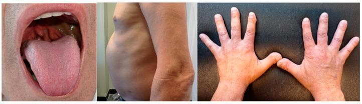 This composite of three clinical photographs displays hallmark physical signs associated with Tangier disease (ABCA1 deficiency). The left panel illustrates the oropharynx, showing characteristic hyperplastic, orange-colored tonsils, a pathognomonic sign resulting from the accumulation of cholesteryl esters in lymphoid tissue. The middle panel presents a lateral view of the patient's torso, demonstrating a significantly distended abdomen indicative of massive hepatosplenomegaly. The right panel displays the dorsal surface of both hands, revealing digital clubbing (hippocratic fingers), characterized by the loss of the Lovibond angle and increased curvature of the nail bed. Collectively, these images illustrate the systemic clinical manifestations of a severe lipid metabolism disorder, highlighting key diagnostic landmarks in the physical examination including reticuloendothelial organomegaly and characteristic mucosal pigmentary changes.