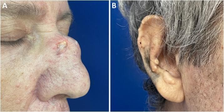 This clinical photograph consists of two panels illustrating cutaneous manifestations of tophaceous gout in a 62-year-old patient. Panel A displays the nasal region in a profile view, featuring a large, firm, erythematous nodule on the nasal dorsum. The lesion is notable for its central ulceration and yellowish-white amorphous discharge, characteristic of urate crystal deposits (tophus). Surrounding skin shows telangiectasia and smaller satellite papules. Panel B provides a lateral view of the right external ear, demonstrating multiple small, firm, yellowish-white papules and nodules along the helix and antihelix. These lesions are discrete, non-ulcerated, and represent classical gouty tophi in a common anatomical site. The image serves as an educational reference for identifying extra-articular manifestations of chronic hyperuricemia and the varied morphology of tophi, ranging from small auricular papules to large, ulcerating facial nodules.