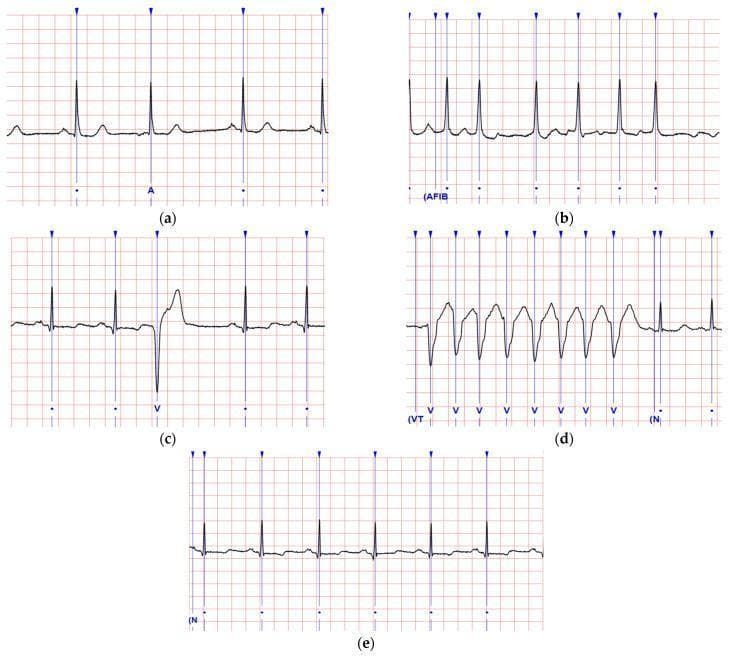 A comparison chart of five electrocardiogram (ECG) waveforms illustrating common cardiac rhythms and arrhythmias. (a) Atrial Premature Complex (APC) shows a standard sinus rhythm interrupted by an early beat with a visible but differently shaped P wave. (b) Atrial Fibrillation (AFib) is characterized by an irregularly irregular R-R interval and an oscillating baseline with absent P waves. (c) Ventricular Premature Complex (VPC) demonstrates a premature, wide, and bizarre QRS complex followed by a compensatory pause. (d) Ventricular Tachycardia (VT) displays a rapid, regular sequence of wide, monomorphic QRS complexes with a saw-tooth appearance and no discernible P waves. (e) Normal Sinus Rhythm (NSR) serves as a baseline, showing regular R-R intervals, consistent P waves, and narrow QRS complexes. The diagnostic images are displayed on a standard red grid for temporal and voltage measurement, utilized for medical education on cardiac electrophysiology and rhythm interpretation.