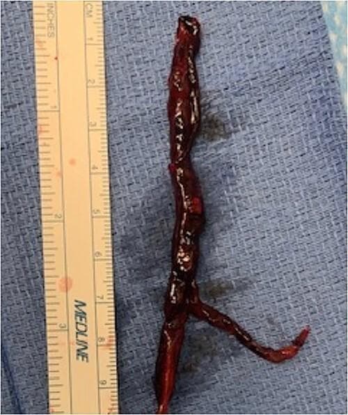 This clinical photograph displays a gross specimen of an extracted thrombus from the left pulmonary artery (LPA), positioned vertically against a blue surgical drape alongside a metric/imperial ruler for scale. The specimen is a subacute pulmonary embolism, approximately 10 cm in length with a maximum width of roughly 1 cm. Visually, the thrombus exhibits a dark, reddish-brown color indicative of coagulated blood and a glistening, irregular surface texture. Its morphology is predominantly elongated and cylindrical, featuring several constrictions along its proximal segment. Notably, the distal portion of the clot demonstrates a bifurcation (branching), which likely corresponds to the anatomical vascular branching of the segmental pulmonary arteries. This image illustrates the physical characteristics of a large-vessel pulmonary embolism potentially identified during donor lung procurement or back-table preparation in the context of lung transplantation. Such specimens are critical for medical education regarding thrombotic pathology and vascular surgery.