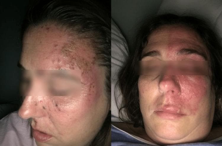 Clinical photograph of a patient's face demonstrating skin manifestations of herpes zoster (shingles) with a classic dermatomal distribution. The image consists of two views: a lateral profile of the left side and an anterior-posterior view. On the left side of the face, there is a cluster of erythematous, vesicular, and hemorrhagic crusted lesions. These lesions follow the sensory distribution of the ophthalmic (V1), maxillary (V2), and mandibular (V3) branches of the trigeminal nerve. A sharp midline demarcation is visible, where the intense erythema and papular lesions end abruptly at the facial midline, characteristic of varicella-zoster virus reactivation. The affected area involves the left forehead, eyelid, nose, cheek, and upper lip. The presence of lesions on the tip and side of the nose (Hutchinson's sign) indicates involvement of the nasociliary branch of the ophthalmic nerve, raising clinical concern for ocular complications. This image serves as an educational example of trigeminal zoster and associated post-herpetic trigeminal neuralgia manifestations.