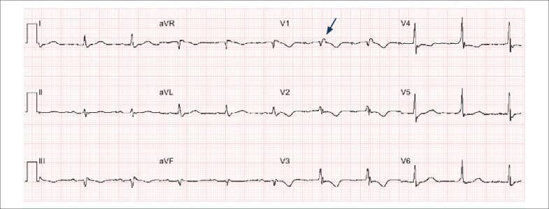 This diagnostic image is a 12-lead electrocardiogram (ECG) demonstrating key diagnostic features of Arrhythmogenic Right Ventricular Cardiomyopathy (ARVC). The tracing shows a normal sinus rhythm with low voltage in the frontal plane leads (I, II, III, aVR, aVL, aVF). A pathognomonic 'epsilon wave' is identified by a blue arrow in lead V1, appearing as a small, low-amplitude notch or positive deflection at the end of the QRS complex and the beginning of the ST segment. Significant repolarization abnormalities are present, specifically deep T-wave inversions across the right precordial leads (V1, V2, and V3). These findings, particularly the combination of terminal notch depolarization (epsilon wave) and precordial T-wave inversion, serve as major diagnostic criteria for ARVC. The educational focus of the image is to illustrate ECG manifestations of right ventricular disease and structural heart conditions associated with sudden cardiac arrest.