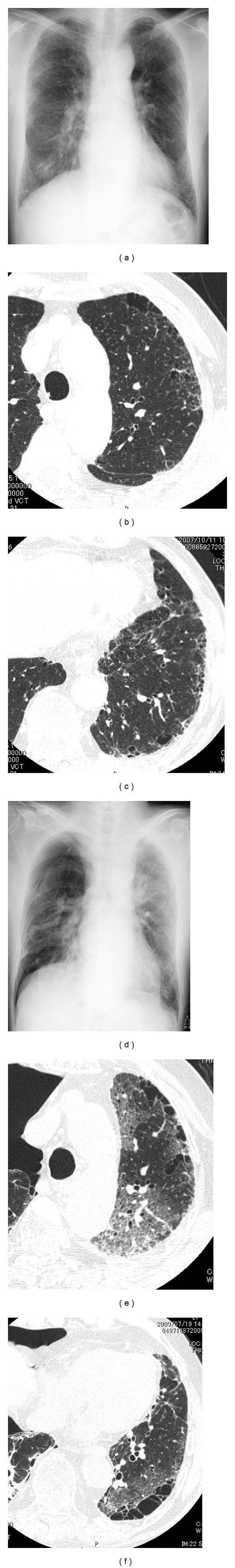 This composite of six diagnostic images (two chest X-rays and four HRCT scans) illustrates the progression of combined pulmonary emphysema and fibrosis (CPFE) into acute exacerbation, potentially triggered by anticancer medication. Images (a-c) represent the baseline state: the chest X-ray (a) shows normal lung volumes with bilateral lower-zone reticular opacities, while HRCT slices (b, c) demonstrate centrilobular emphysema, subpleural cysts, and a Usual Interstitial Pneumonia (UIP) pattern characterized by reticular opacities abutting the chest wall. Images (d-f) depict the acute exacerbation phase: the follow-up chest X-ray (d) reveals new diffuse ground-glass opacities (GGO) in the left lung and a right-sided pneumothorax. The corresponding HRCT scans (e, f) confirm diffuse, bilateral GGO superimposed on the pre-existing emphysematous and fibrotic changes. This series serves as an educational example of monitoring interstitial lung disease and identifying radiological signs of acute respiratory decompensation, such as superimposed ground-glass attenuation and secondary pneumothorax in the context of underlying pulmonary fibrosis.