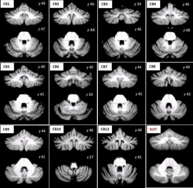 This diagnostic image set features T1-weighted MRI scans of the cerebellum and brainstem from eleven patients with Spinocerebellar Ataxia type 2 (SCA2), labeled CB1 through CB12 (excluding CB11). The scans are presented in representative axial (z-plane) and coronal (y-plane) sections, all normalized to the Spatially Unbiased Infratentorial Template (SUIT) shown in the bottom right for comparison. The educational focus is on the spectrum of cerebellar atrophy characteristic of SCA2. Morphological changes across the patient cohort include a significant reduction in cerebellar volume, narrowing of the cerebellar folia, and prominent widening of the cerebellar sulci and fissures compared to the healthy template. Specific variations are visible in the cerebellar vermis and hemispheres, ranging from mild volume loss to severe shrinkage (e.g., CB6 and CB10). These neuroimaging findings demonstrate the progressive neurodegenerative effects on the posterior fossa structures, which are essential for diagnosing and monitoring the clinical severity of autosomal dominant ataxias.