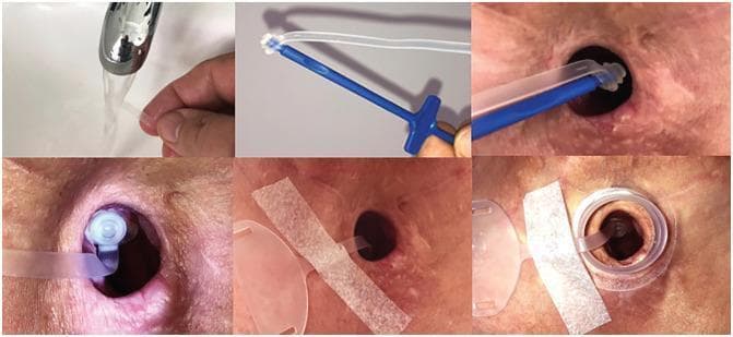 This clinical photographic series illustrates a six-step procedural sequence for the insertion and securing of a tracheostomy plug, commonly used in post-laryngectomy or tracheostomy care. The first frame shows the preparation phase, involving the rinsing or lubrication of a flexible silicone plug under a water stream. The second frame depicts the plug attached to a blue, ergonomic insertion tool (mandrel). The third and fourth frames show the clinical application: the insertion of the plug into a well-healed tracheostomy stoma. The fifth frame demonstrates the securement phase, where a transparent safety strap is taped to the peristomal skin using medical-grade adhesive tape. The final frame shows the completed assembly, with the plug fully seated and an adhesive baseplate or housing applied over the stoma site to facilitate the attachment of additional heat and moisture exchangers (HME) or speaking valves. This series serves as an educational guide for patient self-care or clinician training in stoma management and the prevention of stoma stenosis.