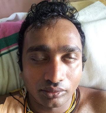 Clinical photograph of a patient's face demonstrating bilateral lower motor neuron facial nerve palsy (CN VII). The image highlights lagophthalmos, where both eyelids are only partially closed despite an attempt at full closure. A positive Bell's phenomenon (Bell's sign) is clearly visible bilaterally, characterized by the upward and outward rotation of the globes, exposing the white sclera beneath the incompletely closed eyelids. The mid-to-lower face shows relative symmetry at rest with neutral oral commissures, suggesting the deficit primarily impacts upper facial musculature or is uniformly bilateral. This visual is typical for clinical presentations of bilateral facial paralysis, which can be seen in systemic neurological conditions such as Guillain-Barré syndrome (specifically the Miller Fisher variant or facial diplegia subtype). The photograph serves as an educational resource for identifying cranial nerve pathology and distinguishing between upper and lower motor neuron signs.