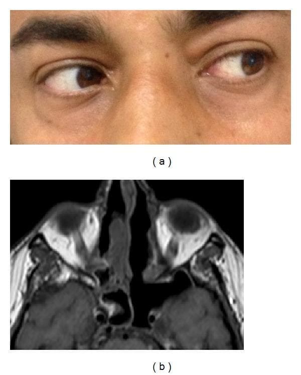 This composite image consists of two parts: a clinical photograph (a) and a diagnostic axial MRI (b), illustrating postoperative recovery from left abducens nerve palsy. Figure (a) is a close-up clinical photograph of the ocular region showing a patient performing a left lateral gaze. The left eye demonstrates full lateral excursion, indicating a complete resolution of the lateral rectus muscle deficit and recovery of the sixth cranial nerve function. Figure (b) is an axial T1-weighted MRI of the paranasal sinuses and orbits. It demonstrates an abnormally enlarged left sphenoid sinus cavity, which is post-surgical following endoscopic sinus surgery (ESS) for invasive actinomycosis. The MRI shows successful resolution of the previously described expansive formation in the parasellar region and cavernous sinus. Key anatomical landmarks include the orbits, nasal septum, and the sphenoid sinus. The material serves as an educational example of the clinical and radiological outcomes after surgical and medical treatment of invasive fungal rhinosinusitis involving the cavernous sinus.
