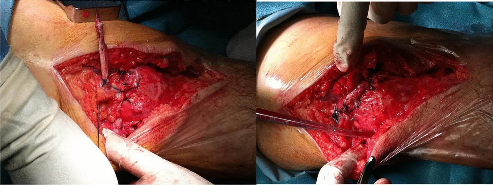 This clinical photograph set depicts an intraoperative view of an orthopedic surgical procedure, specifically a quadriceps tendon rupture repair. The image shows a large, open surgical site on the anterior aspect of the knee. The exposed anatomy includes the subcutaneous adipose tissue, the patella, and the proximal retracted stump of the quadriceps tendon. Key visual features involve the application of a tendon graft secured with multiple black, non-absorbable sutures. These sutures are visible anchoring the graft material to both the periosteum at the patellar tunnel exit holes and to the proximal tendon stump using a series of interrupted knots. Hemostasis is partially managed, with visible areas of clotted and fresh blood within the wound bed. The procedural focus illustrated is the terminal stage of a figure-of-eight graft augmentation used to bridge and reinforce the primary quadriceps tendon repair, demonstrating the method of attachment and suture patterns required for functional stability of the extensor mechanism.