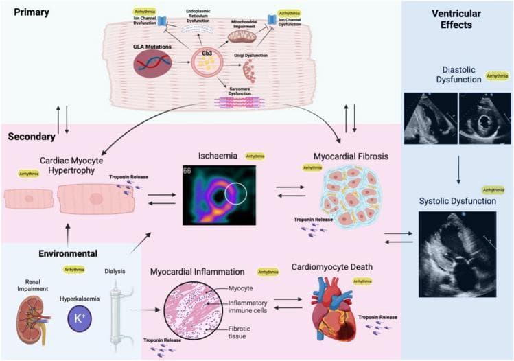 This pathophysiology diagram illustrates the multi-level mechanisms leading to arrhythmia in Fabry Disease (FD), categorized into primary, secondary, environmental, and ventricular effects. The 'Primary' section focuses on cellular dysfunction, showing GLA mutations leading to Gb3 accumulation, which triggers endoplasmic reticulum dysfunction, mitochondrial impairment, Golgi dysfunction, sarcomere dysfunction, and direct ion channel dysfunction. The 'Secondary' section details macro-level pathological changes: cardiac myocyte hypertrophy, myocardial ischemia (represented by a perfusion scan), myocardial fibrosis, and cardiomyocyte death, all associated with troponin release and designated as pro-arrhythmic. 'Environmental' factors include renal impairment, hyperkalemia (K+), and dialysis, which contribute to myocardial inflammation (depicted via histopathology showing myocytes, inflammatory cells, and fibrotic tissue). The final column, 'Ventricular Effects,' displays diagnostic ultrasound images correlating these processes with clinical stages of diastolic and systolic dysfunction. The diagram uses arrows to establish bidirectional relationships between hypertrophy, ischemia, fibrosis, and inflammation, highlighting the complex, interrelated substrate for both atrial and ventricular arrhythmias in FD.