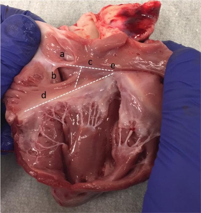 This clinical photograph displays a dissected human heart, specifically focusing on the internal anatomy of the right atrium and the right ventricular inflow tract. White dotted lines delineate the Triangle of Koch, a critical anatomical landmark for cardiac electrophysiology. The primary boundaries and related structures are labeled: (a) the fossa ovalis, shown as a shallow depression; (b) the ostium of the coronary sinus; (c) the tendon of Todaro, appearing as a subendocardial fibrous band; (d) the septal leaflet of the tricuspid valve annulus; and (e) the central fibrous body near the apex of the triangle. The inferior portion of the image reveals the complex architecture of the right ventricle, including the delicate chordae tendineae and papillary muscles associated with the tricuspid valve. This image serves as an educational reference for identifying the site of the atrioventricular (AV) node, which resides within the Triangle of Koch, and is essential for understanding cardiac conduction system localization during surgical or catheter-based interventions.