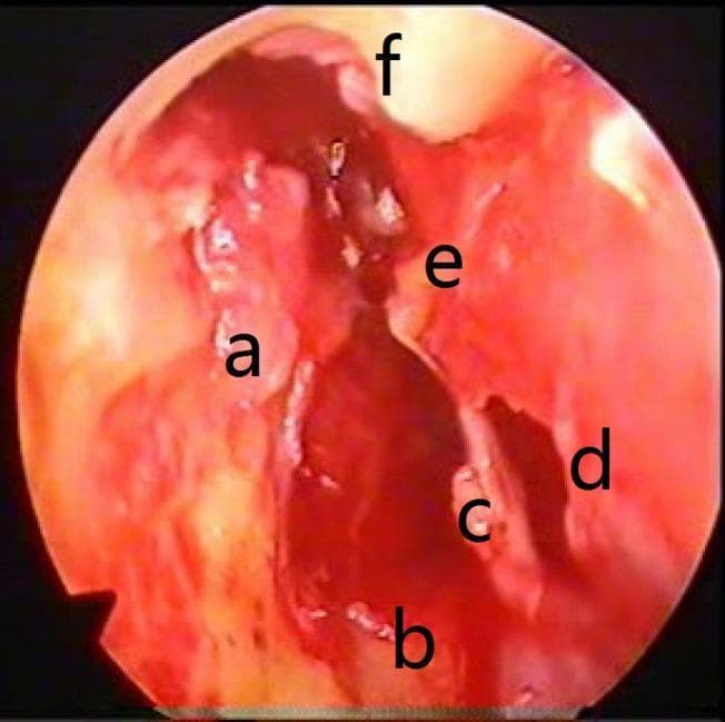 This clinical photograph displays a preoperative endoscopic view of the human middle ear, demonstrating significant pathology associated with chronic otitis media. The image shows a large area of cholesteatoma and inflammatory granulation tissue (a) localized around the stapes and facial recess. Anatomical landmarks include the malleus (e), which remains visible, and the Eustachian tube opening (b) located anteriorly. A prominent tympanic membrane perforation (d) is seen posteriorly, adjacent to the hypotympanum (c). Additionally, there is evident bone destruction in the superior aspect of the canal wall, identified as scutum erosion (f). The mucosal surfaces appear erythematous and thickened, characteristic of chronic inflammation. This image illustrates key diagnostic features used in otolaryngology for assessing the extent of middle ear disease and planning surgical interventions like tympanomastoidectomy.