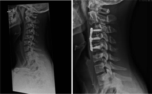 This side-by-side lateral cervical spine X-ray comparison illustrates the pre-operative and post-operative states of a patient with Hirayama disease and cervical kyphosis. The pre-operative image on the left demonstrates a significant kyphotic deformity centered between the C3 and C5 vertebral levels, characterized by an anterior curvature and defined intervertebral disc spaces. The post-operative image on the right shows the result of an anterior cervical discectomy and fusion (ACDF) procedure spanning C3 to C5. Visible instrumentation includes an anterior cervical plate secured with six screws into the C3, C4, and C5 vertebral bodies. The post-surgical alignment reveals a notable correction of the kyphosis toward a more neutral or lordotic curvature. Intervertebral spaces at the operated levels are no longer distinct, indicating the placement of fusion cages or bone grafts to promote solid osseous union. Measurements like the cervical sagittal vertical axis (cSVA) are indicated by vertical lines, showing the change in global alignment from 3 mm pre-operatively to 27 mm post-operatively at long-term follow-up.