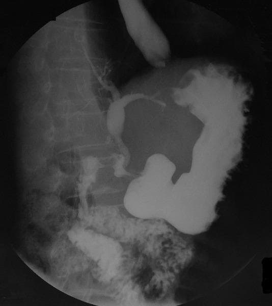 This diagnostic fluoroscopic image is a barium meal study (upper gastrointestinal series) demonstrating a choledochoduodenal fistula (CDF). The image shows radiopaque contrast material opacifying the esophagus, stomach, and a deformed duodenal bulb. Critically, there is clear evidence of contrast reflux from the duodenum into the biliary tract, resulting in the opacification of the common bile duct and intrahepatic bile ducts. This retrograde filling of the biliary tree is a pathological finding indicating an abnormal communication between the gastrointestinal and biliary systems. The duodenal bulb appears distorted, consistent with chronic peptic ulcer disease which can lead to fistula formation. This radiographic study is highly characteristic for diagnosing spontaneous internal biliary fistulas, where contrast or air (pneumobilia) occupies the biliary tree. This material is useful for teaching radiology and gastroenterology students about the complications of severe duodenal ulcers and the application of barium studies in identifying hepatobiliary anomalies.