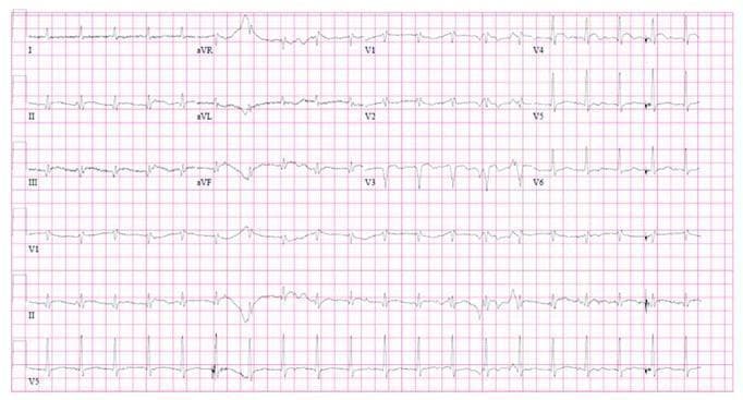 A 12-lead electrocardiogram (ECG) demonstrating signs of an acute anterolateral ST-elevation myocardial infarction (STEMI). The tracing reveals significant ST-segment elevation in the precordial leads, most prominently in V3 and V4, accompanied by prominent, positively deflected T-waves. Subacute Q-wave formation is visible in lead V3. Reciprocal ST-segment depression is noted in the inferior leads, specifically Lead III and aVF. The rhythm appears to be sinus tachycardia with a narrow QRS complex. This diagnostic image illustrates the electrical manifestations of acute coronary occlusion, likely involving the left anterior descending (LAD) artery, and serves as a critical educational example for identifying early-stage ischemic changes and localized anterior wall injury patterns in emergency cardiology.