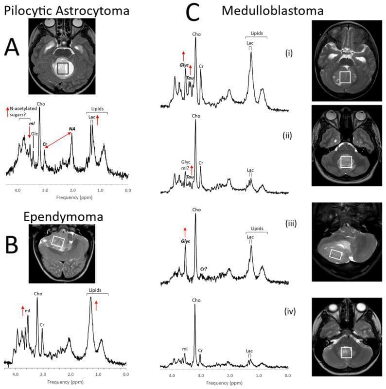This educational image displays Proton MR Spectroscopy (1H-MRS) profiles and corresponding T2-weighted axial MRIs for common pediatric posterior fossa tumors. Panel A illustrates Pilocytic Astrocytoma, characterized by elevated lactate (Lac), lipids, and N-acetylated sugars (~3.8 ppm), with low creatine (Cr) and myo-inositol (mI). Panel B shows Ependymoma, featuring variable lipid levels and myo-inositol peaks. Section C provides a comparison of four Medulloblastoma molecular subgroups: (i) Group 3, (ii) Group 4, (iii) Sonic Hedgehog (SHH), and (iv) WNT. The medulloblastoma spectra generally demonstrate high Choline (Cho) peaks and varying presence of Taurine (Tau) and Glycine (Glyc) at ~3.4-3.5 ppm. The accompanying axial MRI scans show the voxel placement (white boxes) within the cerebellum and fourth ventricle for each tumor type. These metabolic fingerprints assist in differentiating highly cellular medulloblastomas from other cerebellar lesions and investigating subgroup-specific biomarkers. All spectra were acquired at 3T using SV-PRESS (TE=35ms, TR=2s).