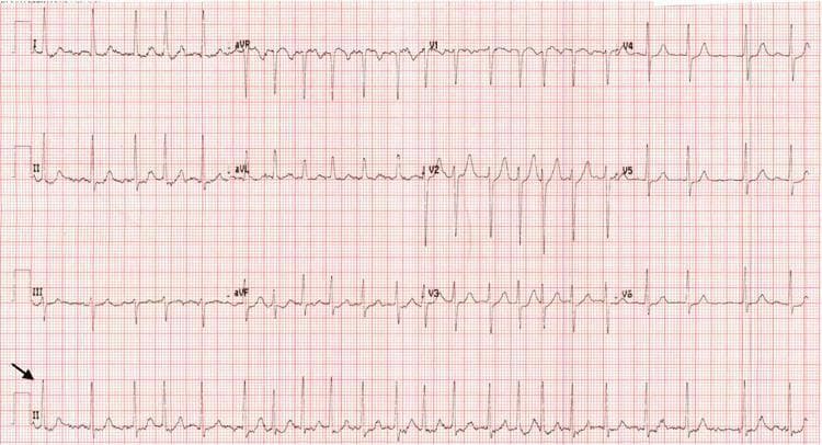 This diagnostic image is a 12-lead electrocardiogram (ECG) printed on standard grid paper, demonstrating new-onset atrial fibrillation. The ECG displays the standard limb leads (I, II, III), augmented limb leads (aVR, aVL, aVF), and precordial leads (V1-V6), with a rhythm strip for lead II at the bottom. The tracing is characterized by an irregularly irregular rhythm and the absence of discernible P waves. In their place, the baseline exhibits fine, irregular fibrillatory (f) waves, most prominently seen in lead V1 and the rhythm strip (indicated by a black arrow). The QRS complexes appear narrow and vary in their R-R intervals, a hallmark of irregular ventricular response in atrial fibrillation. Precordial leads V1 through V6 show a progression of R-wave amplitude. There is no evidence of significant ST-segment elevation or depression, suggesting an absence of acute myocardial infarction. This visual serves as a classic educational example of atrial fibrillation pathophysiology and diagnostic ECG features.