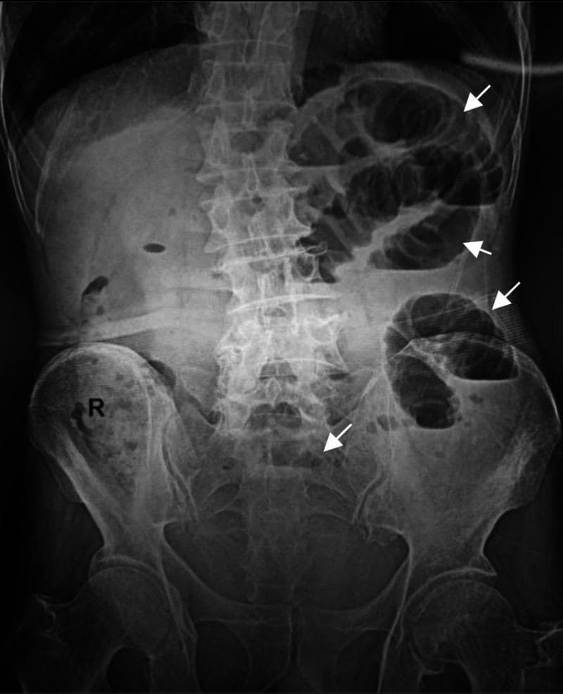 This diagnostic image is an upright plain film abdominal radiograph (X-ray) demonstrating signs of a small bowel obstruction. The radiograph shows multiple dilated loops of small bowel, primarily localized in the left upper and middle abdominal quadrants. Key diagnostic features include the presence of several distinct air-fluid levels within these dilated loops, indicated by white arrows. The valvulae conniventes (plicae circulares) are visible, confirming the loops are small intestine rather than large bowel. The distal bowel appears relatively gasless. Visible anatomical landmarks include the lumbar spine, the bony pelvis, and the bilateral hip joints. There is no clear evidence of pneumoperitoneum (free intraperitoneal air) under the diaphragm. This clinical presentation is highly suggestive of a mechanical bowel obstruction, which contextually was later identified as being secondary to an incarcerated obturator hernia.